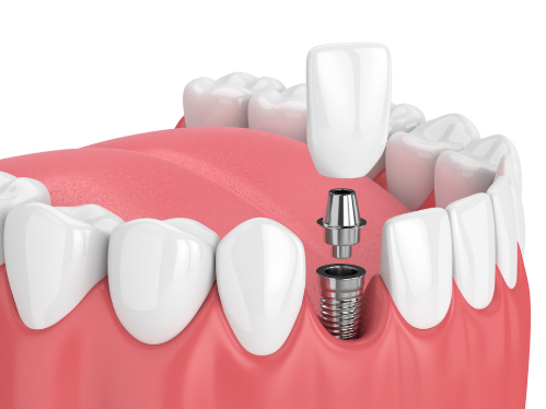 Was sind die Vorteile von Zahnimplantaten?